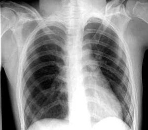 Chest X-ray